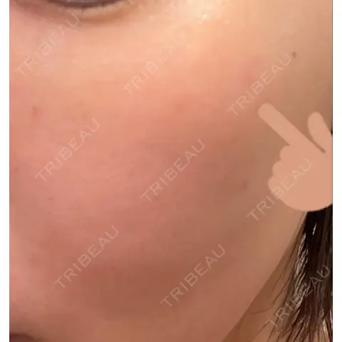 シミ取りレーザー PICO BEAUTY CLINIC AFTER
