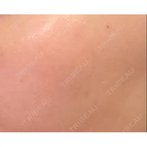 シミ取りレーザー PICO BEAUTY CLINIC AFTER
