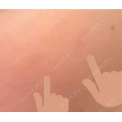 シミ取りレーザー PICO BEAUTY CLINIC AFTER