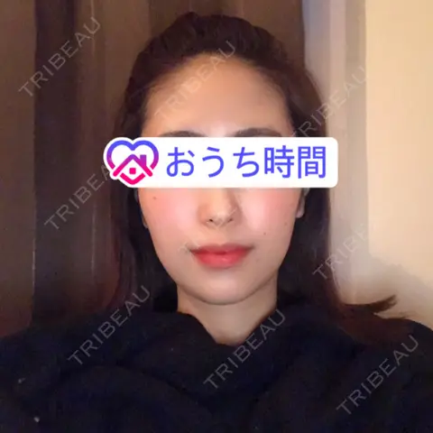 ボトックス（エラ・小顔） / ハイフ（顔） 湘南美容クリニック 渋谷アネックス院 AFTER