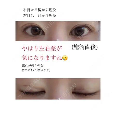 二重埋没 / 二重切開 / 目元修正 共立美容外科 仙台院 DAY 0