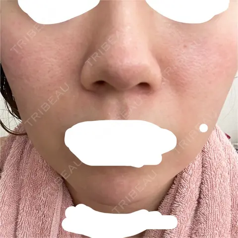 ダーマペン VENUS BEAUTY CLINIC　銀座院 AFTER