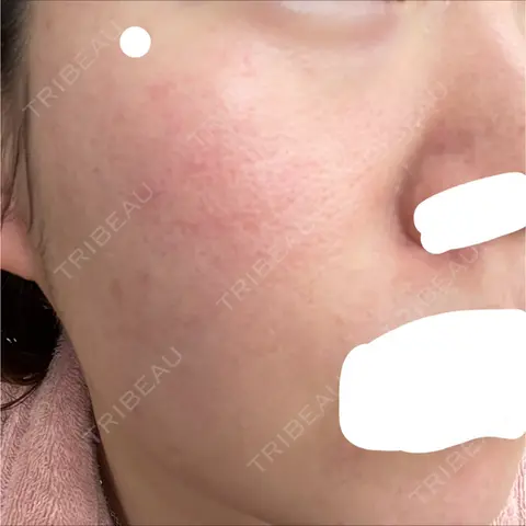 ダーマペン VENUS BEAUTY CLINIC　銀座院 AFTER