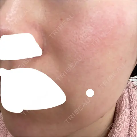 ダーマペン VENUS BEAUTY CLINIC　銀座院 AFTER