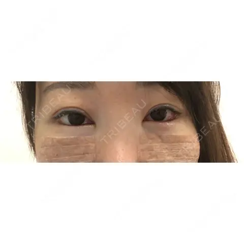 クマ治療 麹町皮ふ科・形成外科クリニック DAY 0