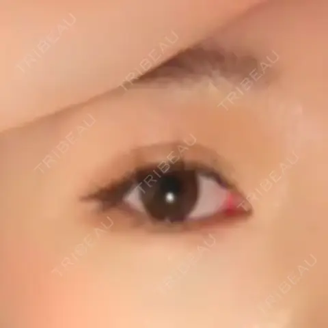 目頭切開 湘南美容クリニック 柏院 AFTER