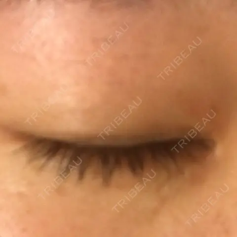 目頭切開 湘南美容クリニック 柏院 AFTER
