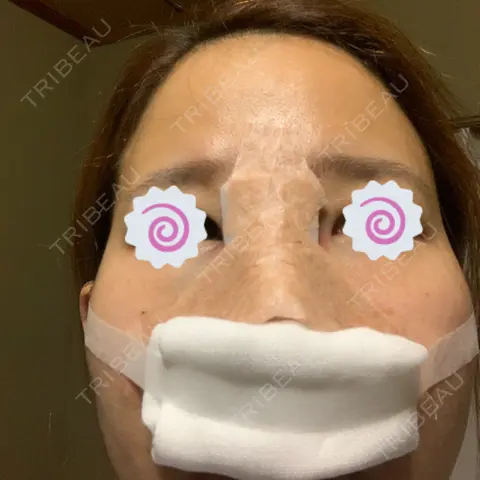 隆鼻術 / 鼻中隔延長（切開） / 軟骨移植 / 鼻尖縮小 しらさぎ形成クリニック 徳島院 DAY 0