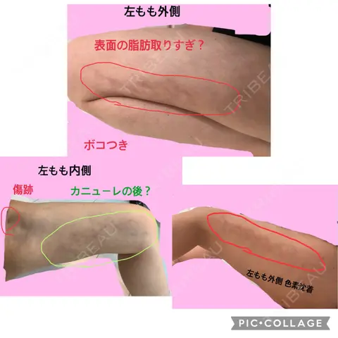 脂肪吸引（脚） / 脂肪吸引（お尻） アサミ美容外科 名古屋院 AFTER
