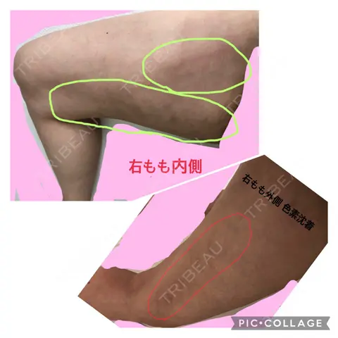 脂肪吸引（脚） / 脂肪吸引（お尻） アサミ美容外科 名古屋院 AFTER