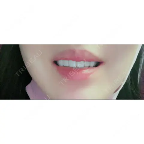 セラミック 湘南美容歯科 大宮院 DAY 0