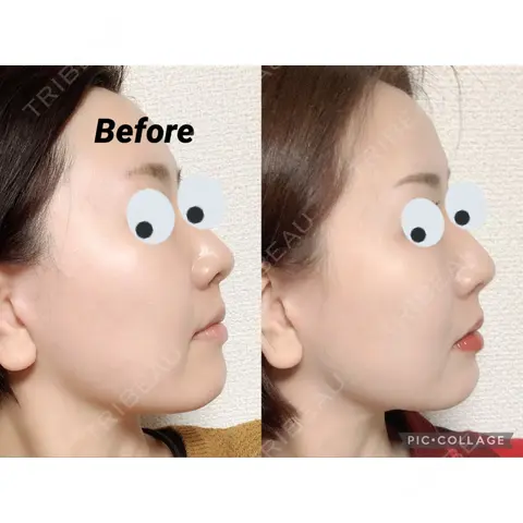 脂肪溶解注射（顔） Beauty Clinic the GINZA AFTER