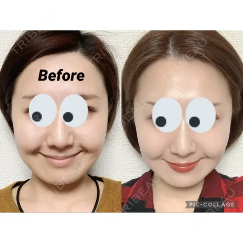 脂肪溶解注射（顔） Beauty Clinic the GINZA AFTER
