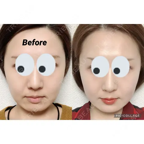 脂肪溶解注射（顔） Beauty Clinic the GINZA AFTER