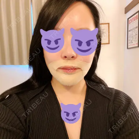 脂肪吸引（顔） / セットバック アーククリニック DAY 1