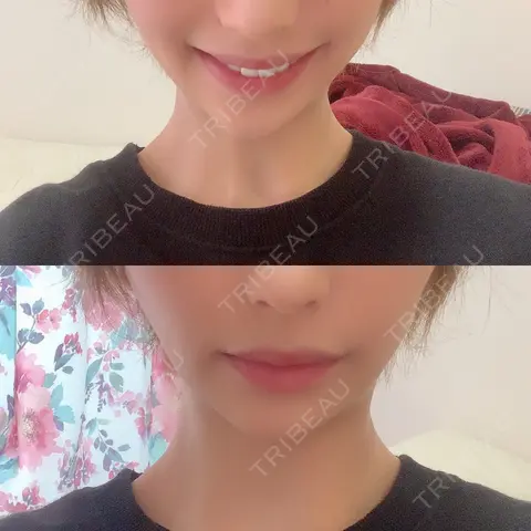 バッカルファット除去 R Beauty CLINIC 銀座院 AFTER