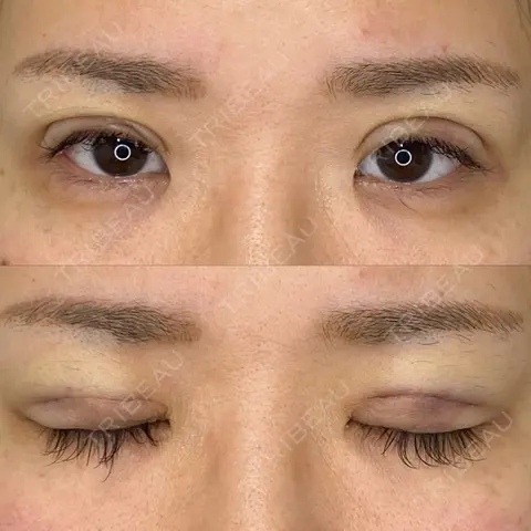 二重埋没 東京BELLEZZAクリニック DAY 0