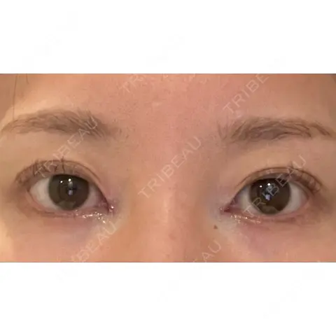 蒙古ひだ形成 R.O.clinic DAY 0