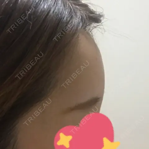 額を丸く ニューセンス皮膚科クリニック AFTER