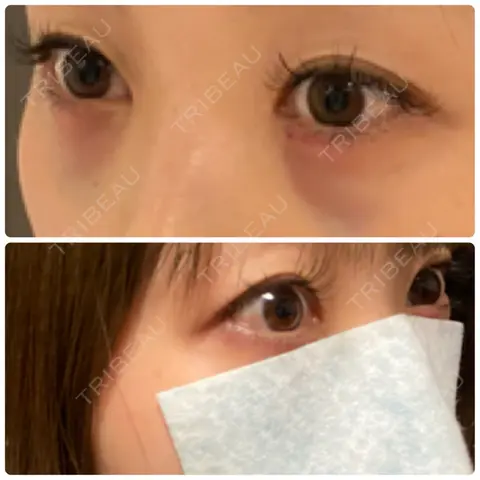 下まぶたの脂肪取り APOLLO BEAUTY CLINIC DAY 0