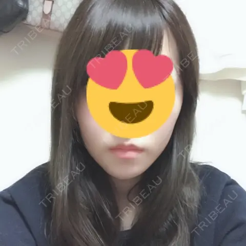 骨切り（あご） リラ・クラニオフェイシャル・クリニック AFTER