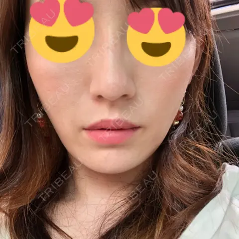 糸リフト 豊洲佐藤クリニック DAY 1