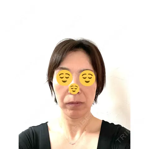 プラセンタ注射 / ハイフ（顔） 心斎橋藤井クリニック DAY 1