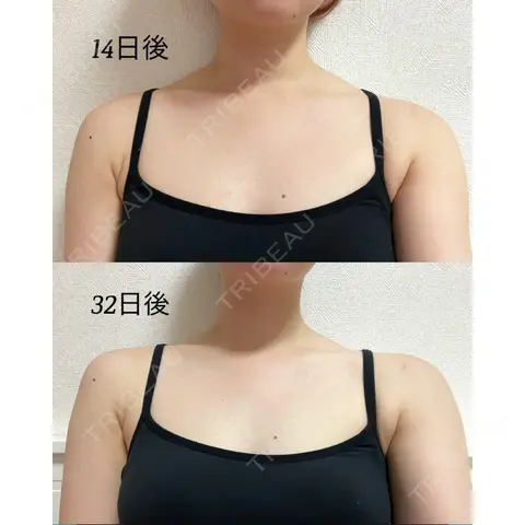 ボトックス（肩） 湘南美容クリニック 西宮北口院 AFTER