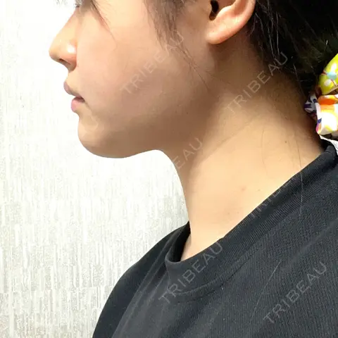 脂肪吸引（顔） 湘南美容クリニック 大阪心斎橋院 AFTER