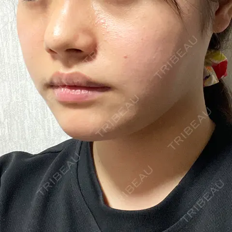 脂肪吸引（顔） 湘南美容クリニック 大阪心斎橋院 AFTER