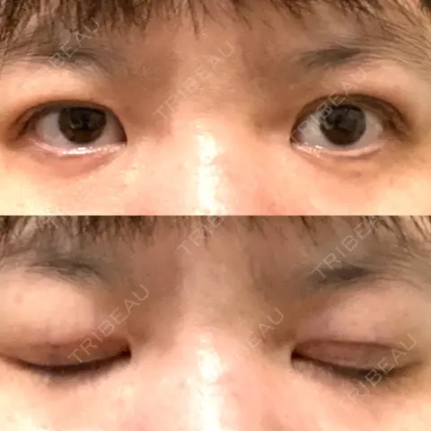 二重埋没 / ヒアルロン酸注入（涙袋） A CLINIC（エークリニック） 銀座院 DAY 0