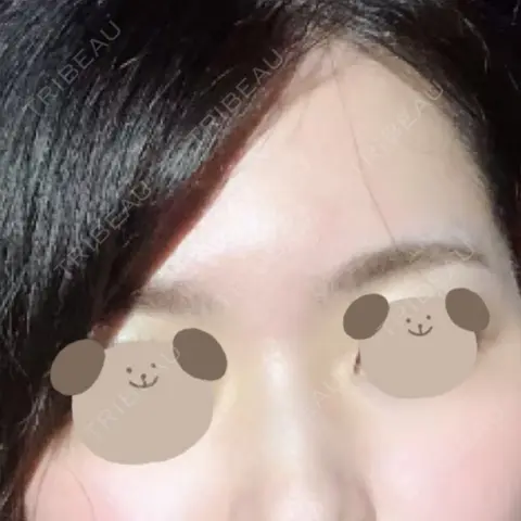 アートメイク（眉） トイトイトイクリニック 池袋院 AFTER