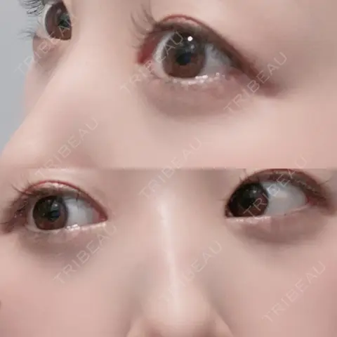 下まぶたの脂肪取り APOLLO BEAUTY CLINIC AFTER
