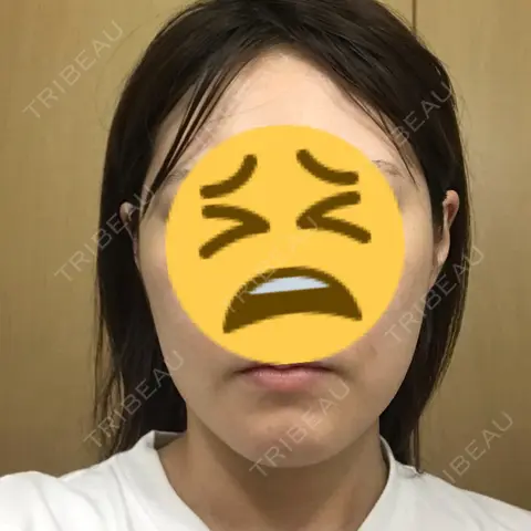 脂肪吸引（顔） 藤・ナチュレ美容クリニック 恵比寿院 DAY 8