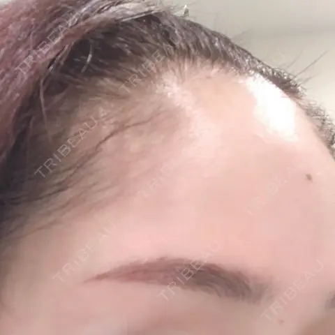 シワ取りボトックス / フォトRF 東京美容皮膚科CLINIC AFTER