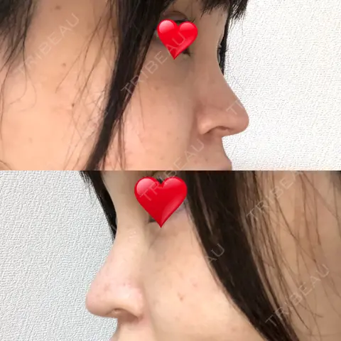 隆鼻術 / 鼻尖形成（切開） / 鼻中隔延長（切開） / 軟骨移植 / プロテーゼ除去 / 鼻修正 THE ROPPONGI CLINIC（ザ 六本木クリニック） AFTER