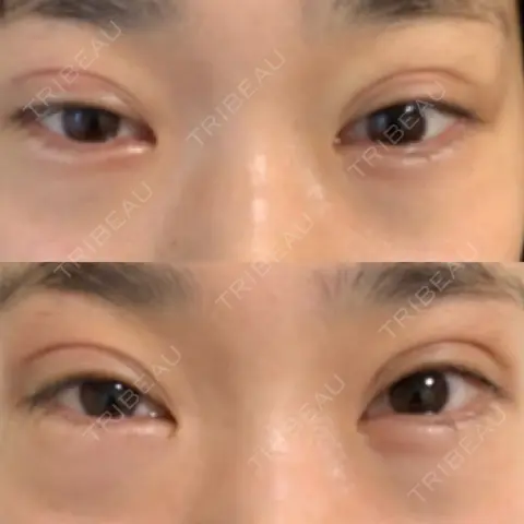 二重埋没 / クマ治療 R Beauty CLINIC 銀座院 DAY 1
