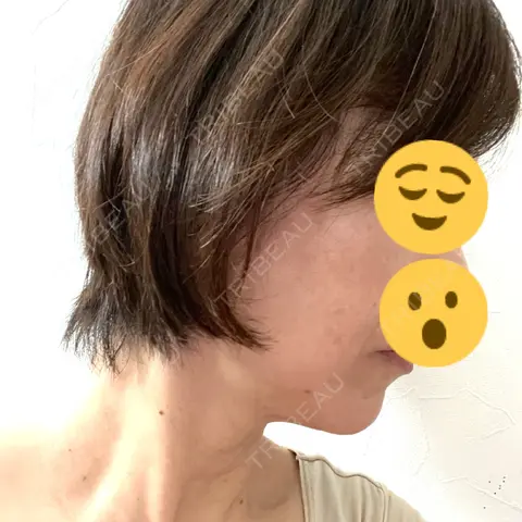 プラセンタ注射 / ハイフ（顔） 心斎橋藤井クリニック AFTER