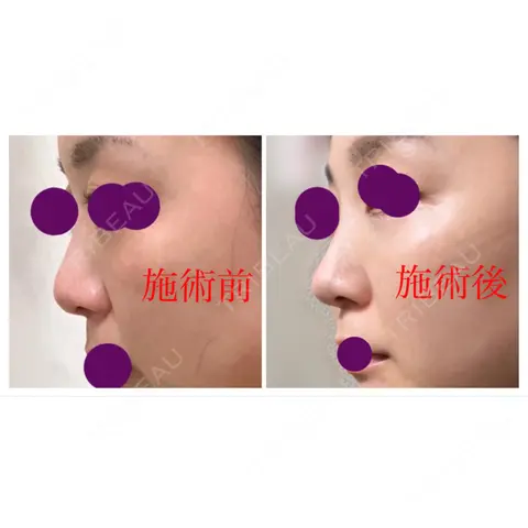軟骨移植 フェアクリニック川口 AFTER