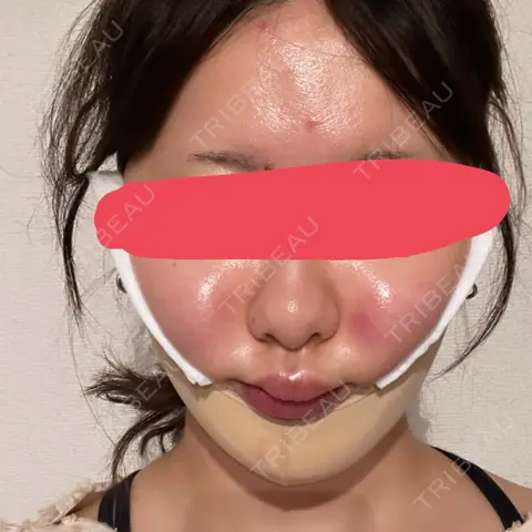 糸リフト / バッカルファット除去 / 脂肪吸引（顔） / メーラーファット除去 SEA CLINIC（シークリニック） DAY 0
