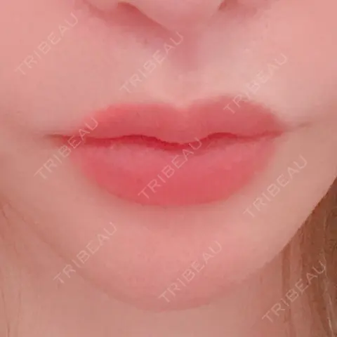 ヒアルロン酸注入（唇） 石倉クリニック 水戸院 AFTER