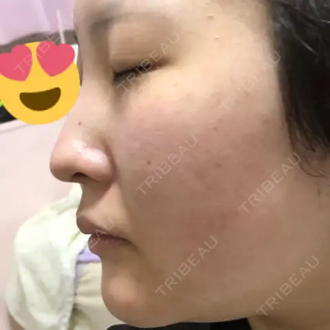 ほくろ・いぼ切除（肌） / 美肌レーザー / シミ取りレーザー / 医療脱毛（顔） / ニキビ治療 加藤病院 AFTER