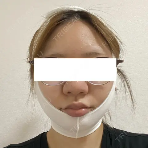 糸リフト / 脂肪吸引（顔） 湘南美容クリニック 岡山院 DAY 0