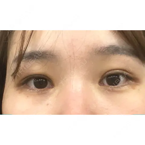 クマ治療 / 下まぶたたるみ取り / 下まぶたの脂肪取り APOLLO BEAUTY CLINIC DAY 0