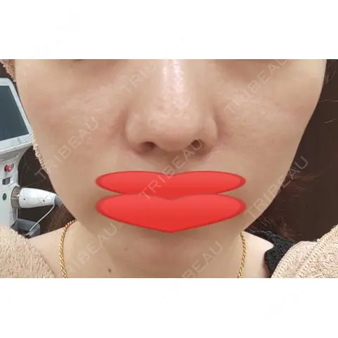 光治療（フォトフェイシャルなど） 東京美容皮膚科CLINIC AFTER