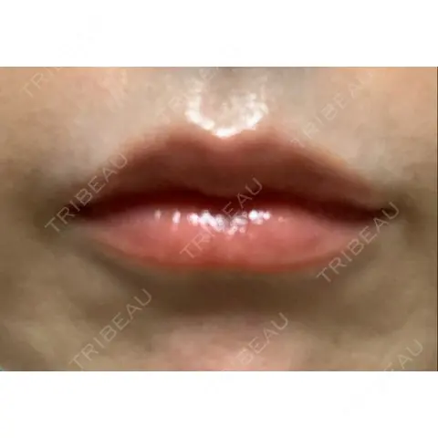 ヒアルロン酸注入（唇） セオリークリニック AFTER