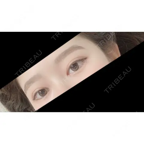 二重切開 品川美容外科 千葉院 AFTER