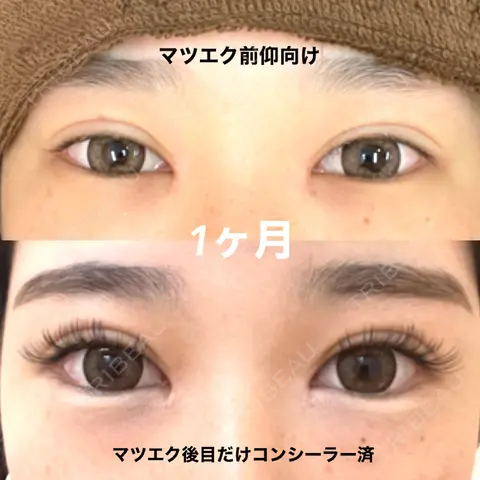 二重切開 / 目頭切開 / 上まぶたたるみ取り サラ美容外科 AFTER