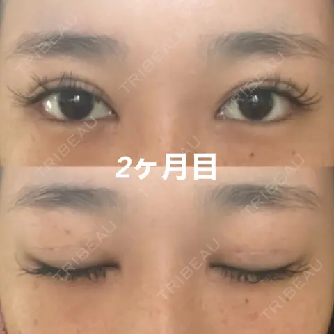 二重切開 / 目頭切開 / 上まぶたたるみ取り サラ美容外科 AFTER