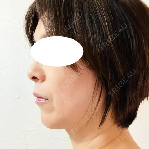 プラセンタ注射 / ハイフ（顔） 心斎橋藤井クリニック AFTER